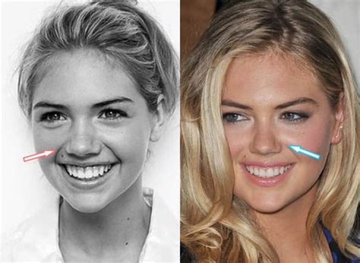 Kate Upton Plastic Surgery Before and After