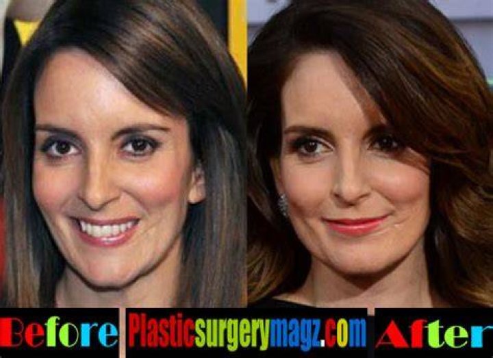 Tina Fey Plastic Surgery Before and After